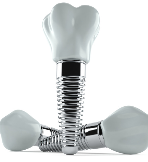 Three dental implants in San Ramon, CA with two lying down