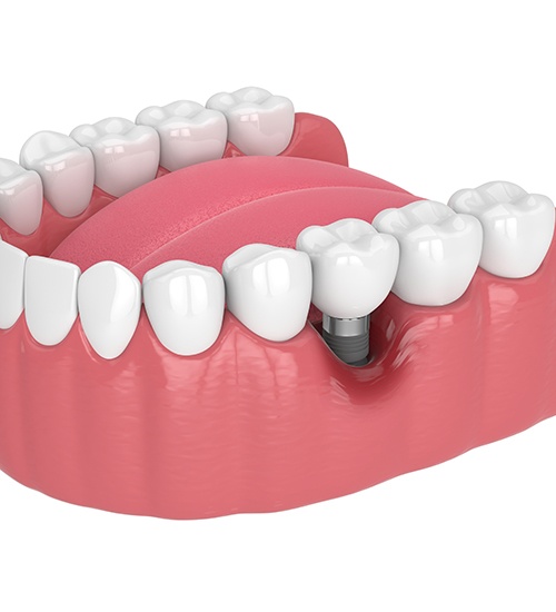 Illustration of a failed dental implant in San Ramon, CA